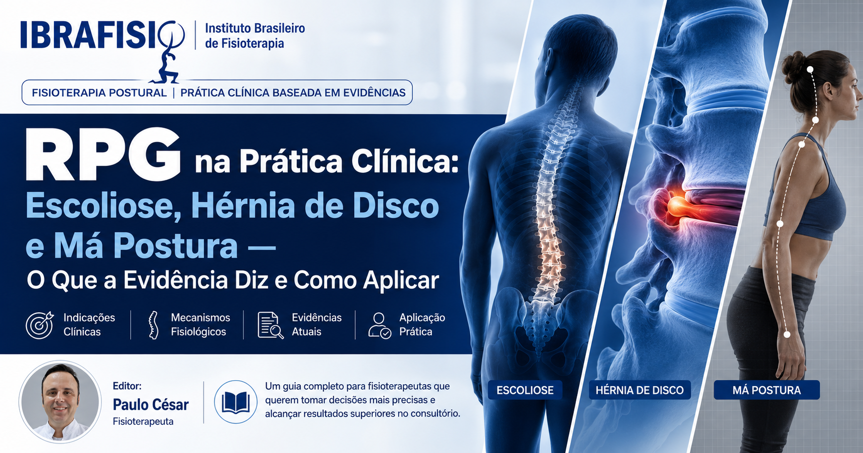 RPG na Prática Clínica: Escoliose, Hérnia de Disco e Má Postura — O Que a Evidência Diz e Como Aplicar